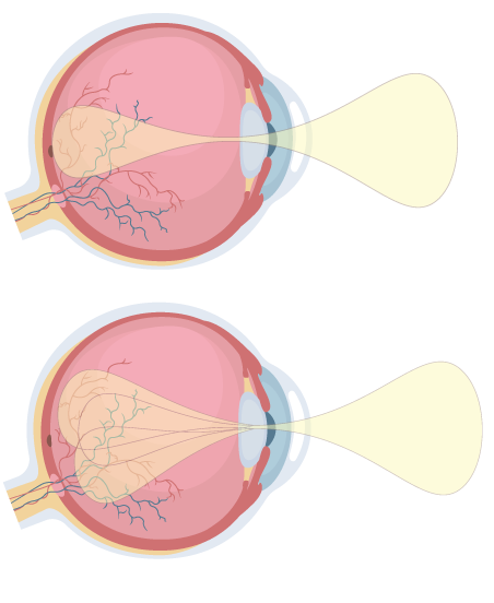 Maladies et troubles oculaires fréquents